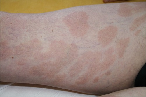 Figure 1 Mycosis fungoides “patches” stage.