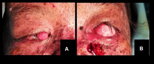 Figure 3 (A) Nodules in the right eye, (B) nodules in the left eye prior to the extirpation biopsy procedure.