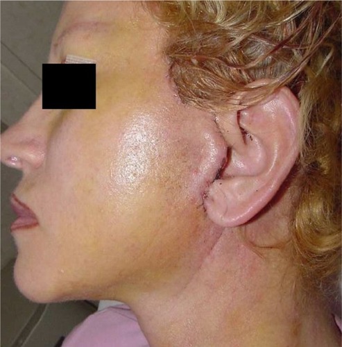 Figure 6 Appearance 3 days postoperatively after removal of eyelid sutures.