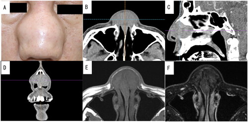 Figure 1. Preoperative photograph of the patient and enhanced computed tomography (CT) and plain magnetic resonance imaging (MRI) images of the nasal sinus of case 1. A well-defined mass measuring 36 × 33 mm was visualized using contrast-enhanced CT without any contrast effect. It had replaced the nasal septal cartilage. Additionally, T1-weighted and T2-weighted MRI revealed a mass with low signal intensity. (A) Preoperative photograph showing swelling from the nasal bridge to the nasal wing. (B) Axial CT image. (C) Sagittal CT image. (D) Coronal CT image. (E) Axial MRI T1-weighted image. (F) Axial MRI T2-weighted image.