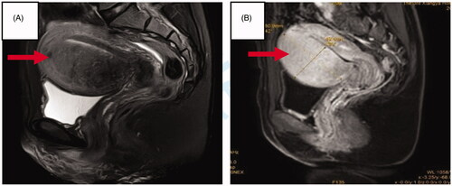 Figure 2. MR images obtained from a patient with adenomyosis. (A) T2WI obtained before HIFU showed the adenomyotic lesion located at anterior wall of the uterus (arrow); (B) Contrast-enhanced MRI showed perfusion of the adenomyotic lesion (arrow).