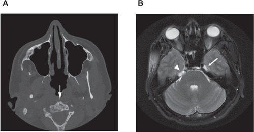 Figure 1 A) Head CT without contrast demonstrating generalized bony changes associated with disseminated lymphangiomatosis. Note the bubbly appearance of the C2 vertebral body (arrow). B) T2-weighted axial MRI image of the head showing a normal cerebral spinal fluid (CSF) signal in the left Meckel’s (trigeminal) cave (arrow). A lesion in the right petrous apex (the bone is not well seen on MRI) has effaced Meckel’s (trigeminal) cave on the right (arrowhead).