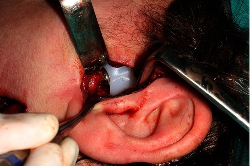 Figure 5 Intraoperative view of TMJ prothesis.