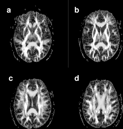Figure 2 A series of axial slices from the FA data of a representative individual. Slices are presented in inferior to superior order from (a – d). The corpus callosum (CC) region of interest is superimposed in yellow.