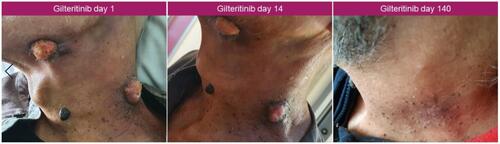 Figure 7 Evolution of the myeloid sarcoma during the treatment with gilteritinib.