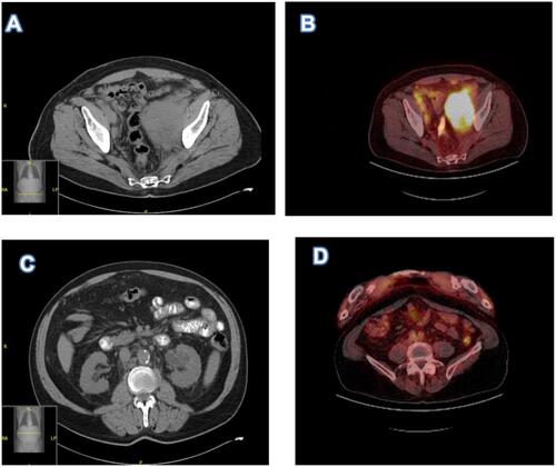 Figure 2 (A) Pretreatment CT imaging showed a left pelvic sidewall mass, pelvic mesenteric lymphadenopathy, and external iliac lymphadenopathy. (B). Pretreatment PET shows hypermetabolic pelvic lesion however unable to accurately measure SUVs in this mass due to concentrated radiotracer within the involved left ureter. (C). Pretreatment CT imaging showed associated left hydronephrosis. (D) Post treatment PET scan after 6 cycles of induction therapy showed low level metabolic activity within the left pelvic sidewall mass, SUV max 2.1, no evidence for recurrence.