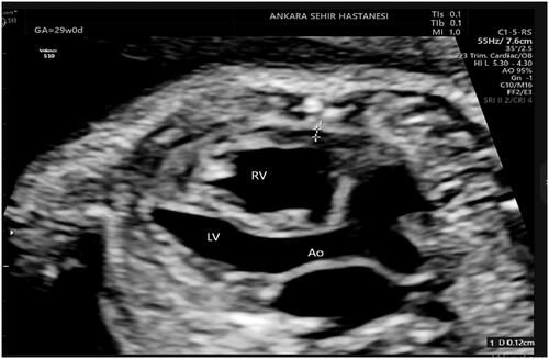 Figure 1. Measurement epicardial fat thickness. LV: left ventricle; RV: right ventricle; Ao: aorta.