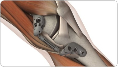 Figure 1 KineSpring® Knee Implant System.