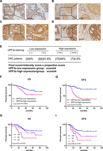 Figure 3 High UPF3a expression correlates with poor survival of CRC patients. (A–D) IHC analysis of different UPF3a expression in CRC patients (magnification: ×200, left panels; ×400, right panels). (A–D) represents negative (-), weakly positive (+), moderately positive (++), and strongly positive (+++) UPF3a expression, respectively. (E) The detailed scoring method of UPF3a expression. (F, G) The Kaplan–Meier plots were stratified by UPF3a expression for disease-free survival and overall survival in CRC patients. Log‐rank test was performed to assess statistical significance. OS: overall survival; DFS:disease-free survival. (H, I) The Kaplan–Meier plots were stratified by tumor stage (I/II, III and IV) for disease-free survival and overall survival in CRC patients. Log rank test was performed to assess statistical significance.Abbreviations: OS, overall survival; DFS, disease-free survival.