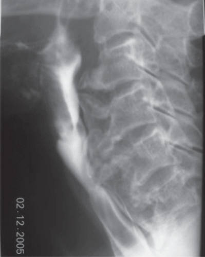 Figure 1 Barium swallow showing indentations on the esophagial lumen caused by anterior osteophyte formations and ossificated anterior longitudinal ligament more prominent at C3–4 and C4–5 levels.