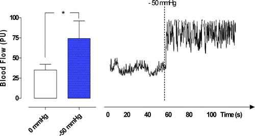 Figure 4.  Microvascular blood flow measured at a depth at 6–8 mm in the myocardium (myocardium) in seven pigs, after 40 minutes of occlusion of the left anterior descending artery and hypothermia at 31°C. Recordings were made before and after the application of a topical negative pressure of −50 mmHg. The results are shown as mean values±SEM. A level of *p < 0.05 was considered statistically significant. The right panel shows a representative example of microvascular blood flow changes before and after application of −50 mmHg. Note the immediate increase in microvascular blood flow response when the negative pressure is applied.