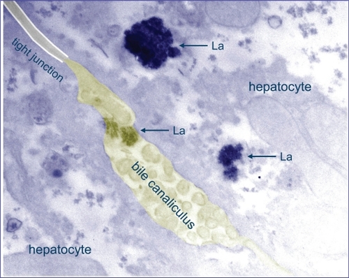 Figure 3 Lanthanum is localized in lysosomes at the biliary pole of hepatocytes. Transmission electron microscopy image of liver tissue of La loaded rat (dose: 0.3 mg/kg/day IV, 4 weeks) showing electron dense precipitates displaying a crystalline granular structure within the lysosomes and bile canaliculus. The presence of lanthanum in these granular structures was evidenced by electron energy loss spectroscopy (EELS). Adapted with permission from Macmillan Publishers, Ltd. Kidney Int. Bervoets AR, Behets GJ, Schryvers D, et al. 2009;75(4):389–398. Copyright © 2008.Citation62