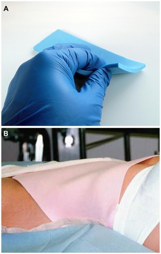 Figure 17 (A) Close-up of closed-cell compression foam (TenderFoam™; T&N Industries, San Diego, CA, USA). (B) Foam in place prior to firm compression.