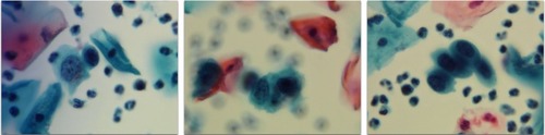 Figure 1 Abnormal SurePath Pap test cells interpreted as “atypical squamous cells, cannot rule out a high-grade squamous intraepithelial lesion” (original magnification 400×); residual SurePath vial fluid tested negative using the Hybrid Capture 2 test for high-risk human papillomavirus.