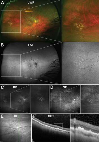Figure 7. (A) UWF imaging of peripheral drusen in the nasal and temporal retina in a 66 year old Caucasian female which appear as (B) hyperfluorescent spots on FAF and (C) hyperreflective lesions on red-free and (D) green free imaging. (E) Infra-red imaging of peripheral drusen in a 56 year old Caucasian male which appear as reflective lesions. (F) OCT through peripheral drusen indicate similar morphology to macular drusen and location in the sub-RPE space. Abbreviations as in Figure 3.