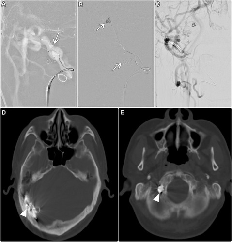Figure 4 (A) The selective roadmap of the lower skull part shows super-selection of paravertebral venous plexus reaching to posterior condylar vein dAVF (arrow). (B) Platinum coils were deployed at the posterior condylar vein dAVF (arrows). (C) The final run shows the total obscuring of posterior condylar vein AVF (asterisk). (D and E) Post-operative computed tomography images reveal complete coil material at the location of posterior Condylar vein dAVF, with embolic material obscuring the lateral sinus Davf (arrowheads).