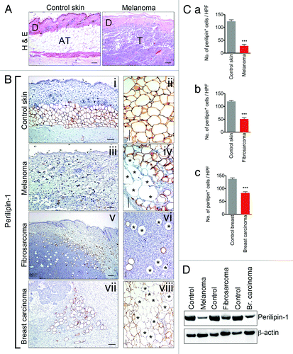 Figure 1. Adipose tissue juxtaposed to implanted tumors is atrophied and demonstrates diminished expression of the lipid storage mediator, perilipin-1. Hematoxylin-eosin histological examination of control mouse skin, size bar = 100 μm (left panel) and mouse model of melanoma, B16F10, size bar = 100 μm (right panel), revealed atrophy of tumor-associated AT. “D” marks dermis, “AT” marks adipose tissue and “T” marks tumor (A). Immunohistochemical analysis of tissue sections from control mouse skin, size bar = 100 μm and 50 μm (B, i and ii) and peritumoral area of melanoma, size bar = 100 μm and 50 μm (iii and iv), fibrosarcoma, size bar = 200 μm and 50 μm (v and vi) and breast carcinoma, size bar = 100 μm and 50 μm (vii and viii) using adipocyte marker, lipid droplet-associated protein, perilipin-1. Perilipin-1 negative adipocyte-like cells are marked by an asterisk. Quantification of perilipin-1+ cells within control mouse skin (n = 3/group) and tumor samples (n = 3/group) revealed decreased numbers of perilipin-1+ cells surrounding tumors (C, a–c). Western blot was performed using control mouse skin and tumor samples with overlying connective tissue. Western blot results revealed decreased levels of perilipin-1 within tumor samples with overlying connective tissue when compared with skin samples (D). Data presented are mean values ± SEM *P < 0.05; **P < 0.01; and ***P < 0.001, the Student t test.