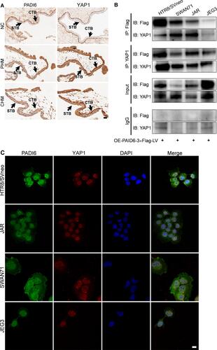 Figure 1 The expression patterns of PADI6 and YAP1. (A) In villi from normal placentas (NC), PHMs and CHMs, Immunohistochemistry staining showed positive PADI6 and YAP1 expression in the CTB and negative PADI6 and YAP1 expression in the STB, and a coexpression pattern was also observed (200×). (B) Co-IP of trophoblast cell lines transfected with oe-PADI6 lentivirus vector including HTR-8/SVneo, SWAN71, JAR and JEG3 cells. (C) Colocalization of PADI6 (green) and YAP1 (RED) in HTR-8/SVneo, SWAN71, JAR and JEG3 cells by confocal microscopy. Bar: 20 µm.