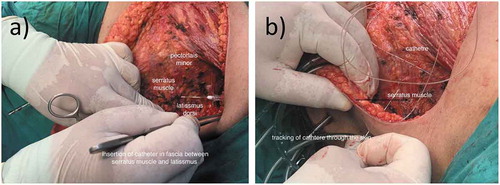 Figure 3. Surgical insertion of the catheter: (a) Insertion of the catheter in the fascial plane between the serratus anterior and the latissimus dorsi muscles. (b) Tracking of the catheter through the skin.