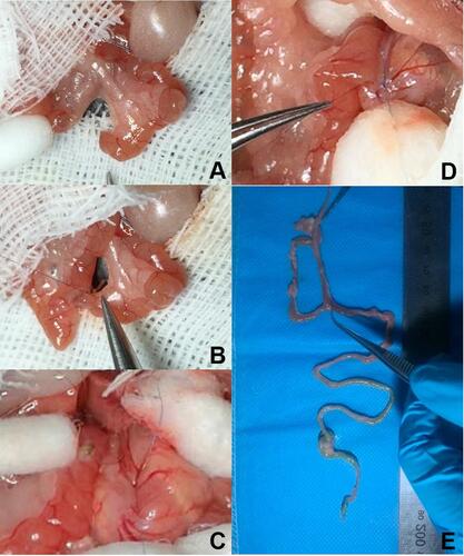 Figure 1 Surgical techniques of RYGB. (A) Jejunum transected proximally to the ligation; (B) end-to-side jejunojejunostomy between BP limb and AL limb; (C) 2 mm–long incisions on AL limb and distal part of esophagus just superior to EGJ; (D) side-to-side anastomosis between distal part of esophagus and AL limb; (E) entire alimentary tract showed completely excluded stomach and patent anastomosis after RYGB.