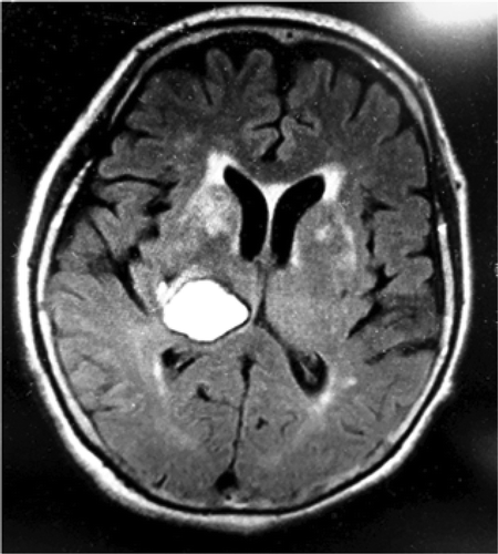 Figure 4. Lesion pattern of case 2 (magnetic resonance imaging fluid-attenuated inversion recovery).