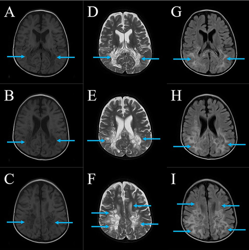 Figure 1 MRI (Plain) of the Brain. (A–C) are T1-weighted; (D–F) are T2-weighted; (G–I) are FLAIR-weighted. (A–C) show hypointense regions and (D–I) show hyperintense regions in the periventricular white matter with multiple cystic spaces. The splenium of corpus callosum is also involved. Blue arrows mark the abnormal regions.