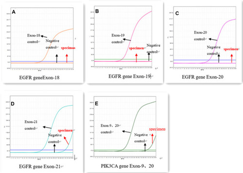 Figure 3 ARMS-PCR gene sequencing illustrated EGFR 18 (A), EGFR 19 (B), EGFR 20 (C) are negative, EGFR 21 (L858R) (D) and PIK3CA (H1047R/E545K) (E) concurrent mutations in AC component.
