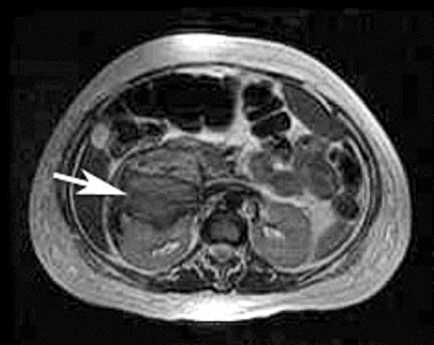 Figure 1. MRI shows complex right perirenal hematoma.