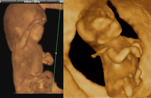 Figure 41.  Mild to moderate wrist contracture seen in cases of trisomy 18 at 12–13 weeks of gestation. Left; Mild wrist contracture is seen. Right; moderate wrist contracture is seen. Trisomy 18 was confirmed by chorionic villi sampling.
