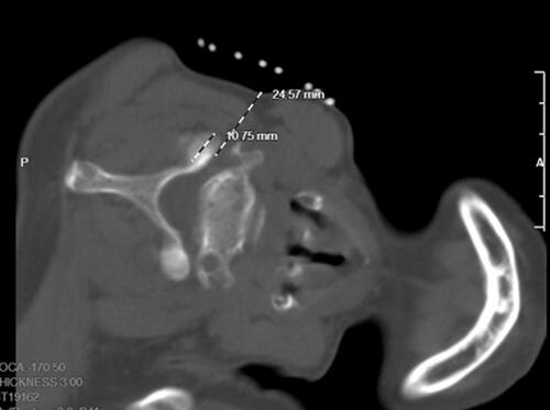 Figure 3 The intervertebral foramen and vertebral artery foramen can be displayed on the same plane. The dorsal point of the foramen was selected as the target point. The orientation of the positional line was parallel to the pedicle of the foramen and the intersection of the extension line and the skin is the needle insert point.