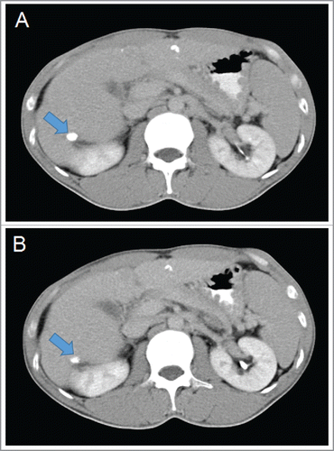 Figure 5. CT images of a 38-year-old man who underwent 6 courses of HANK cell immunotherapy for recurrent HCC. The blue arrows in panels (A) and (B) indicate the tumor. (A) Contrast-enhanced CT scan in the venous phase showing a tumor that was approximately 1.8 × 1.4 cm in size. (B) Contrast-enhanced CT scan taken 3 months after NK cells immunotherapy showing that the size of the tumor was 1.8 × 1.2 cm.