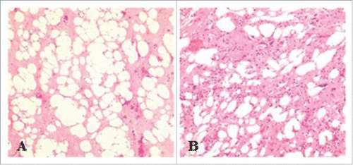 Figure 3. Histopathologic findings. A (original magnification, × 40; hematoxylin and eosin staining) and B (original magnification, × 100; hematoxylin and eosin staining) views demonstrate a well-differentiated liposarcoma.