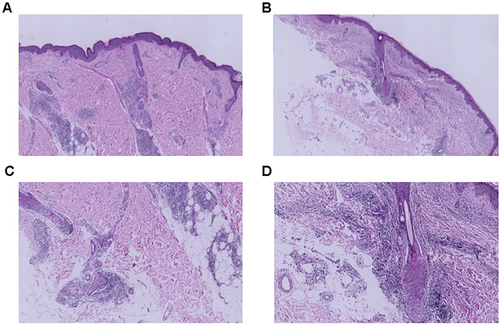 Figure 2 Histopathology results of the skin lesions on the left arm. (A and B) HE staining images results of the skin lesions (X 100). (C and D) HE staining results of the skin lesions (X 400).