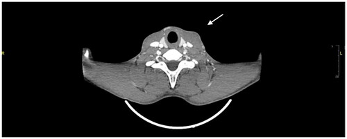 Figure 2. Axial contrast CT image of soft tissues of neck (abdomen window), revealing a 0.8*2.36*2.0 cm liquefied collection superficial to the left SCM muscle (arrow).