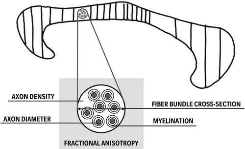 FIGURE 3. Involvement of CC subparts and WM metrics in bimanual performance. This conceptual figure depicts that the majority of the works published on the association between the CC and bimanual performance since 2014 emphasizes the particular importance of the midbody including secondary and primary motor areas, followed by the anterior and then the posterior CC sections (indicated by the density of the hatching reflecting the number of papers reporting a significant association). Additionally, a relationship with bimanual motor behavior based on fractional anisotropy, a measure that is predominantly extracted from CC WM, is biologically difficult to interpret as it is sensitive to a wide variation of tissue properties such as myelination, axon diameter, fiber bundle cross-section, fiber orientation, and vascular morphology (Lazari et al., Citation2021). A suggestion is made to study more biologically relevant WM metrics when associating with behavior.