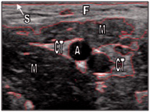 Figure 2. Segmentation of the ultrasound image from the treatment region. Segmentation lines outline the main anatomical structures. S, skin; F, fat; M, muscle; A, artery; CT, connective tissue.