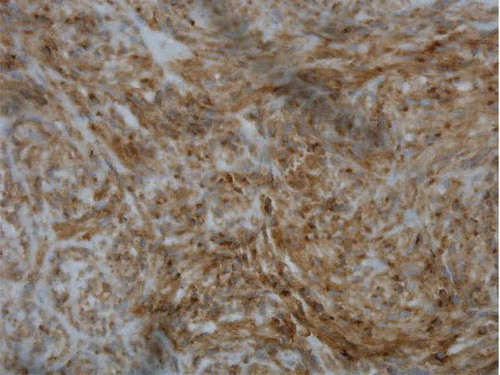 Figure 4. Pathology slide showing CD 117-positive staining of the core biopsy (brown stain).