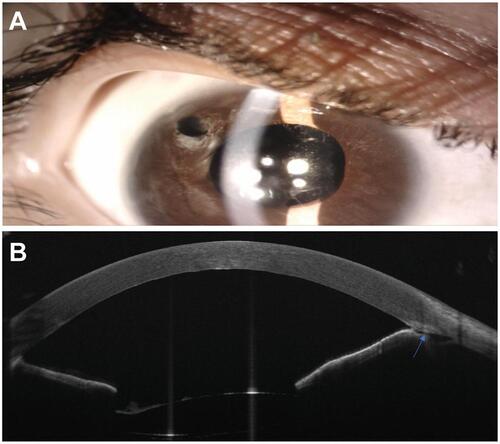 Figure 3 Post-operative examination of the right eye (RE). (A) Post-operative slit-lamp examination of the RE shows deep anterior chamber with a clear cornea, and intraocular lens in place. (B) Post-operative anterior segment-optical coherence tomography of the RE shows deep anterior chamber with surgically created cleft in the trabecular meshwork (arrow).