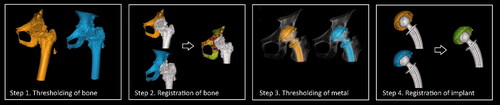 Figure 2. Processing schematic for CTMA. (Step 1) First an optimization of bone thresholding is performed manually. (Step 2) Thereafter the pelvic bone is defined here by the surface of the pelvic anatomy; a first registration is subsequently performed. (Step 3) A manual thresholding of metal is performed. (Step 4) The implant rigid body (the cup) is defined. The user indicates the region of interest for the second registration in the 2 datasets, i.e., the implant. Next the second registration occurs. Green color indicates a successful registration.