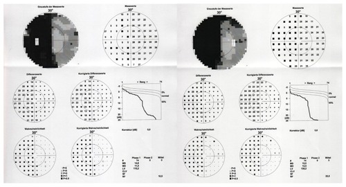 Figure 2 Visual field testing in October 2010 demonstrated a homonymous hemianopia to the left (Octopus 101, 30°, Haag Streit, Germany).