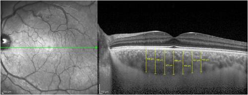 Figure 1 Schematic representation of choroidal thickness measurement. Choroidal Thickness was measured from the outer edge of the hyperreflective line, corresponding to the retinal pigment epithelium, to the choroidal-scleral junction. Measurements were taken at the subfoveal choroid and at 500 µm intervals from the fovea: temporal 500 µm (T500), 1000 µm (T1000), 1500 µm (T1500) and nasal 500 µm (N500), 1000 µm (N1000) and 1500 µm (N1500).