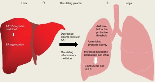 Figure 4 Overview of inflammation caused in AATD liver and lung disease. AAT Z-polymers misfold in the liver leading to retention/aggregation in the ER, resulting in low levels of plasma AAT. Low levels of AAT and active uninhibited serine proteases can cause damage to lung parenchyma ultimately leading to emphysema and COPD.Abbreviations: AAT, alpha-1 antitrypsin; AATD, AAT deficiency; ER, endoplasmic reticulum.