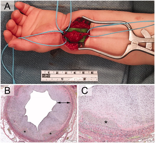 Figure 3. A. Intraoperatively, the lesion was pulsatile, grossly multi-lobular, and reddish and focally bluish in colour with fibrous attachments to the flexor carpi radialis sheath. The radial artery was resected proximally to the mid-forearm and distally just past the wrist flexion crease. Photomicrographs exhibiting pseudoaneurysmal radial artery with scant residual media (asterisks) and striking intimal fibroplasia (arrow). Verhoeff-van Giesson stains (3B) original magnification, ×40. (3C) original magnification, ×500.