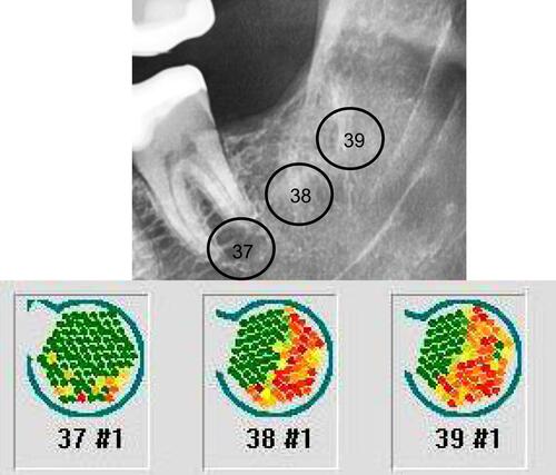 Figure 2 Example of 2D coloring in TAU-n in area 37 = GREEN = solid bone. Area 38 = RED = reduced bone density = fatty-degenerative parts. Retromolar area 39 = RED= decreased bone density = fatty-degenerative parts.