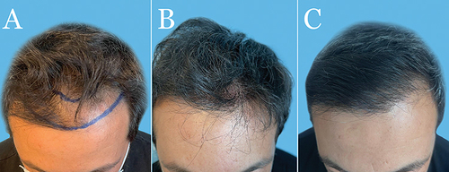 Figure 6 A 36-year-old Caucasian man before long-hair FUE using a skin-responsive FUE device (A). Forty-eight hours after the implantation of 3289 long-shafted grafts to the frontal scalp. Copyright ©2021. Dove Medical Press. Adapted from Umar S, Lohlun B, Ogozuglu T, Carter MJ. A novel follicular unit excision device for all-purpose hair graft harvesting. Clin Cosmet Investig Dermatol. 2021;14:1657–1674Citation6 (B). Three years after surgery (C).