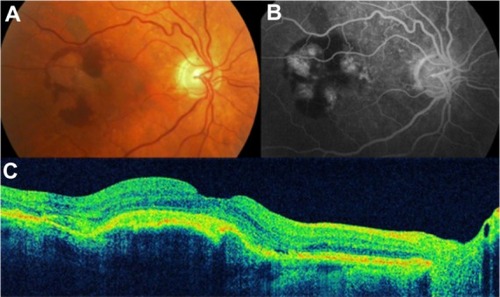 Figure 16 Choroidal neovascularization in age-related macular degeneration.