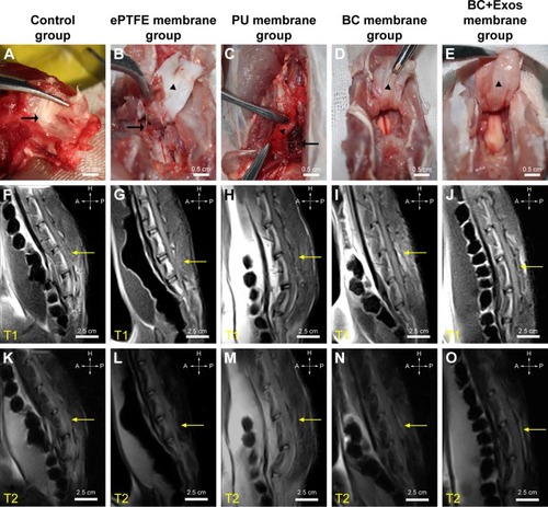 Figure 6 General view and MRI examination.Notes: (A–E) At 1 year postoperatively, the general observation of the control, ePTFE membrane, PU membrane, BC membrane, and BC+Exos membrane groups, respectively. (F–J) At 1 year postoperatively, the T1-weighted MRI images of the control, ePTFE membrane, PU membrane, BC membrane, and BC+Exos membrane groups, respectively. (K–O) At 1 year postoperatively, the T2-weighted MRI images of the control, ePTFE membrane, PU membrane, BC membrane, and BC+Exos membrane groups, respectively.Abbreviations: BC, bacterial cellulose; BC+Exos, bacterial cellulose combined with exosomes; ePTFE, expanded polytetrafluoroethylene; MRI, magnetic resonance image; PU, polyurethane.