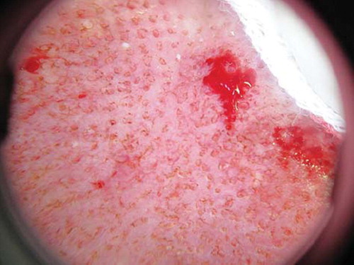 Figure 4. Dermoscopy immediately after laser treatment: small, round treated zones are separated by unaffected zones.