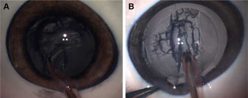 Figure 3 The comparison of surgical field images of pig cadaver eye in cataract surgery (phacoemulsification). (A) Image obtained with the prototype 8K microscopic camera and (B) image obtained with the new 8K UHD microscopic camera.