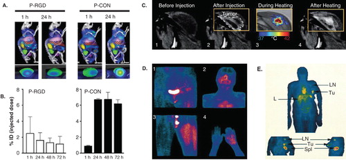 Figure 1. Image-guided drug delivery. (A and B) At the preclinical level, image-guided drug delivery can be used for several different purposes, including for the analysis of active versus passive tumor targeting. Panels A and B show that at early time point after i.v. administration, RGD-modified tumor vasculature targeted polymeric drug carriers accumulate more efficiently within tumors than peptide-free passively targeted polymers. They also show, however, that over time, the latter are more efficient in achieving high tumor concentrations. (C) MR imaging of gadolinium release from temperature-sensitive liposomes before and after heating, exemplifying that image-guided drug delivery can be used to tailor triggered drug release. (D-E) Accumulation of radiolabeled liposomes in tumors in patients, showing that sarcomas tend to accumulate nanomedicine formulations relatively well (D), whereas breast carcinomas present with a relatively low degree of EPR-mediated tumor accumulation (E).